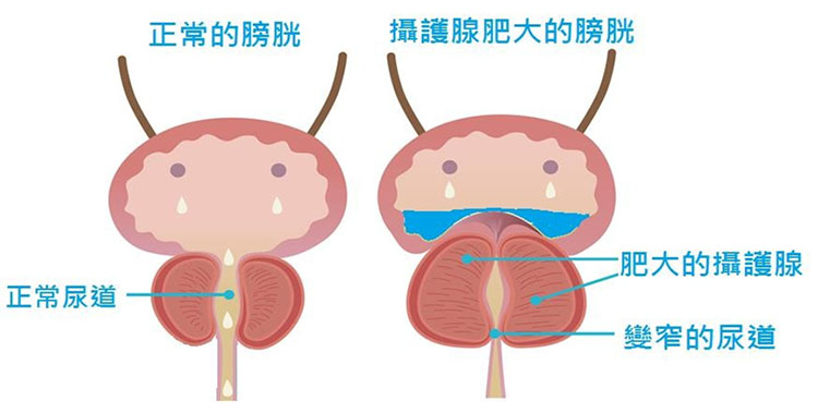 改善攝護腺肥大引起的排尿障礙